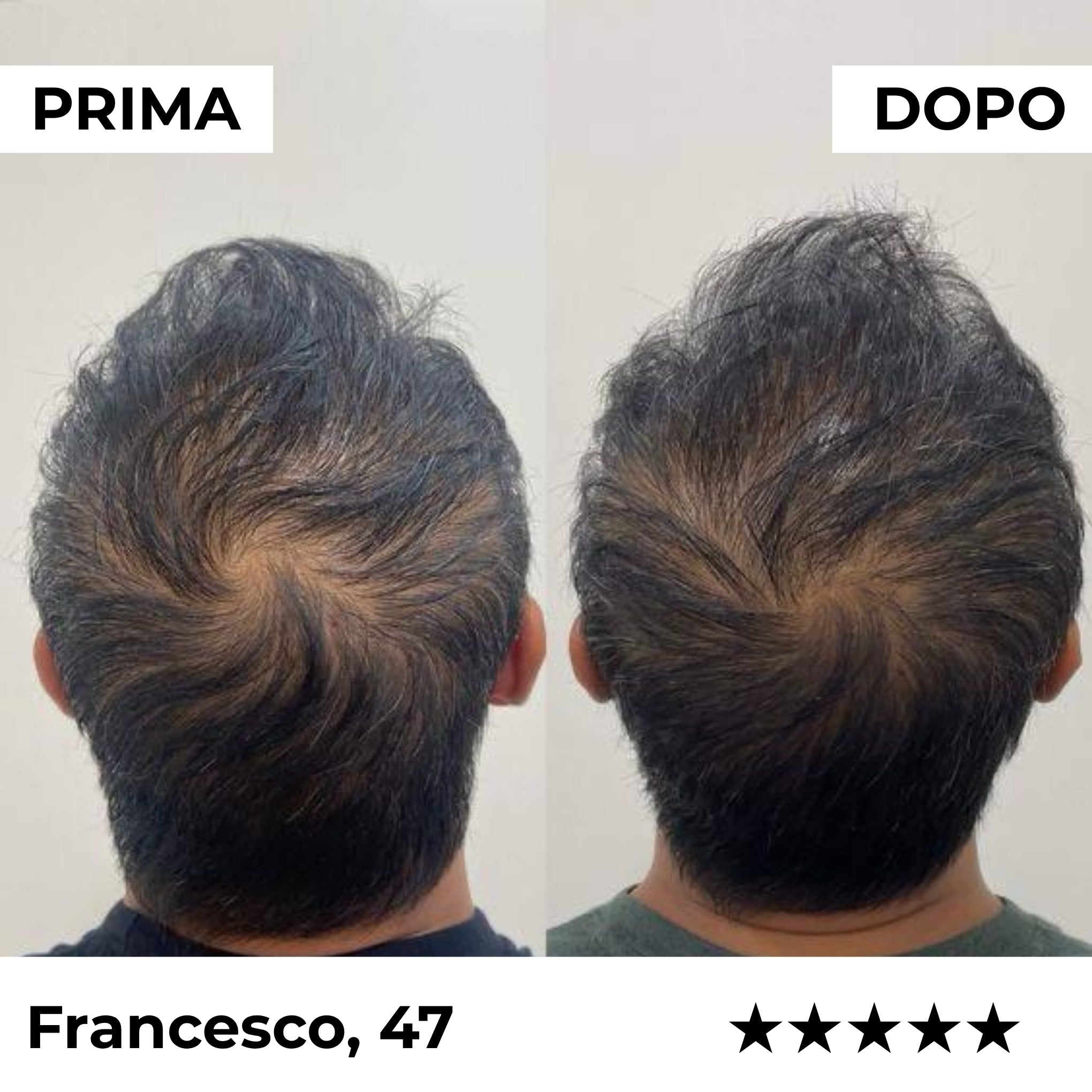 Sistema di Microinfusione Capillare Firmelià PRO®