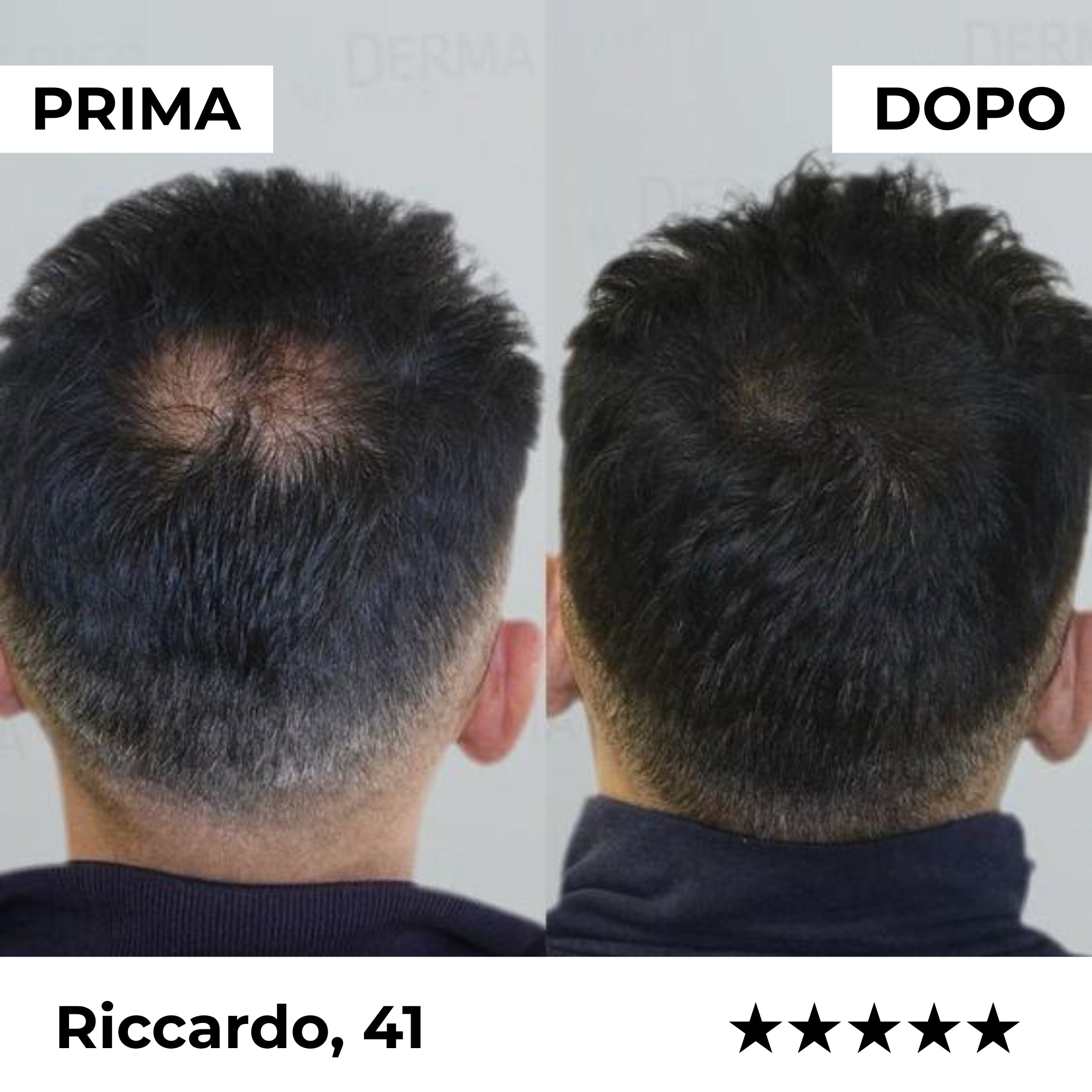 Sistema di Microinfusione Capillare Firmelià PRO®